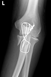Elbow x-rays with tension band wiring